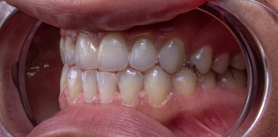 Photo vibrating teeth sensation